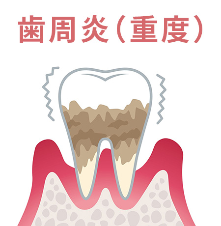 歯周炎（重度）